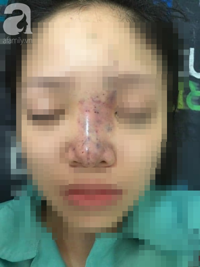 TP.HCM: Nữ sinh viên 19 tuổi biến dạng mặt, suýt mù mắt vì tiêm nâng mũi tại thẩm mỹ viện chung cư - Ảnh 4.