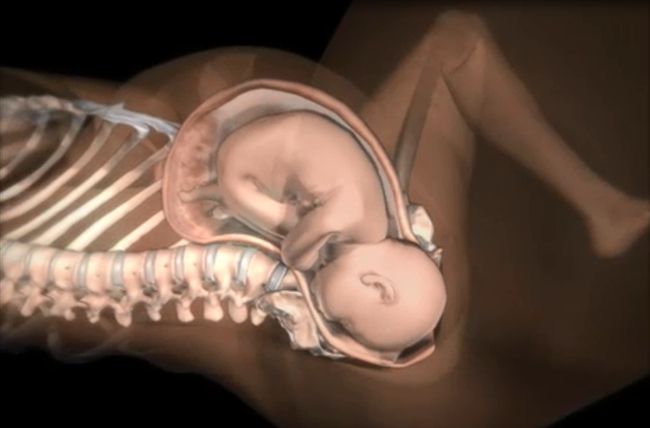 Những điều các mẹ cần biết về tình huống đẻ khó do bé bị kẹt vai trong lúc sinh thường - Ảnh 4.