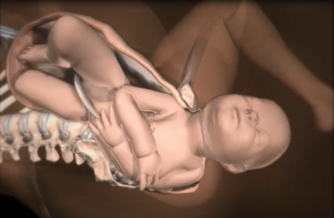 Những điều các mẹ cần biết về tình huống đẻ khó do bé bị kẹt vai trong lúc sinh thường - Ảnh 7.