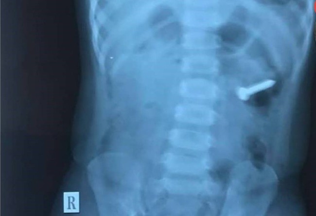 Anh trai 2 tuổi đút cho em ăn, mẹ thấy con ọe tức tốc đưa đi viện và hốt hoảng khi nhìn kết quả X-quang - Ảnh 2.