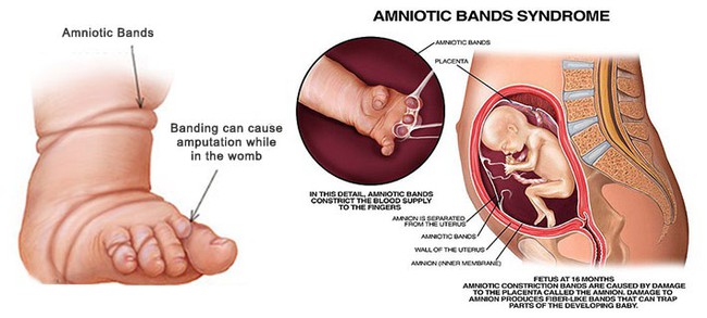 Con vừa chào đời mẹ hốt hoảng khi bác sĩ thông báo phải cắt bỏ chân con vì hội chứng thai kỳ ít người biết - Ảnh 4.