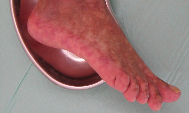 Chân bị bầm tím có thể do những bệnh đáng sợ gây ra vì vậy bạn cần thận trọng - Ảnh 3.