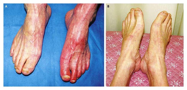 Chân bị bầm tím có thể do những bệnh đáng sợ gây ra vì vậy bạn cần thận trọng - Ảnh 4.