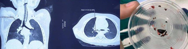 Chuyên gia cảnh báo: Trẻ nhỏ hóc hạt, ho sặc nghẹt đường thở dọa tử vong - Ảnh 2.