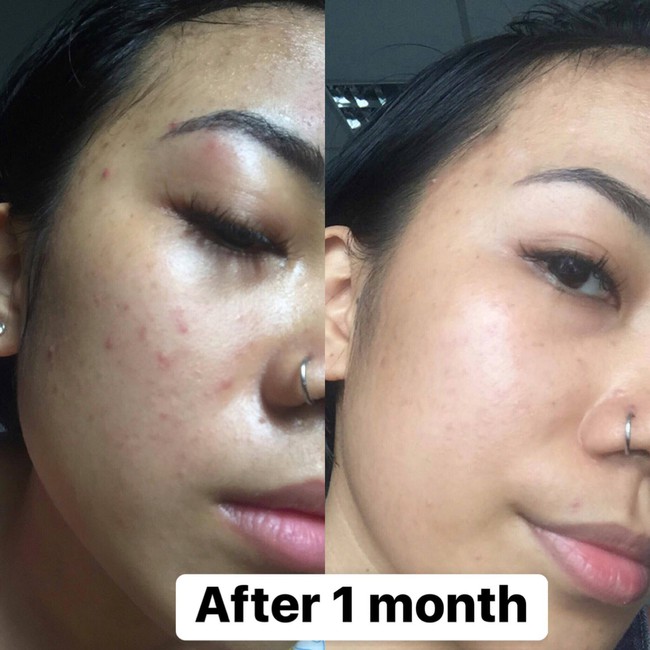 Không hợp mỹ phẩm Hàn, cô nàng này đã thoát khỏi tình trạng mụn và thâm nhờ 8 sản phẩm giá rất sinh viên - Ảnh 5. Không hợp mỹ phẩm Hàn, cô nàng này đã thoát khỏi tình trạng mụn và thâm nhờ 8 sản phẩm giá rất sinh viên - Ảnh 5.