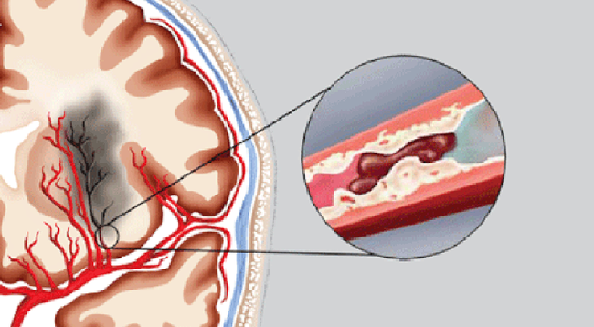 Nếu không muốn mình đột nhiên bị nhồi máu não như người phụ nữ này thì ngay lập tức chấm dứt thói quen xấu mà gần như ai cũng mắc - Ảnh 3.