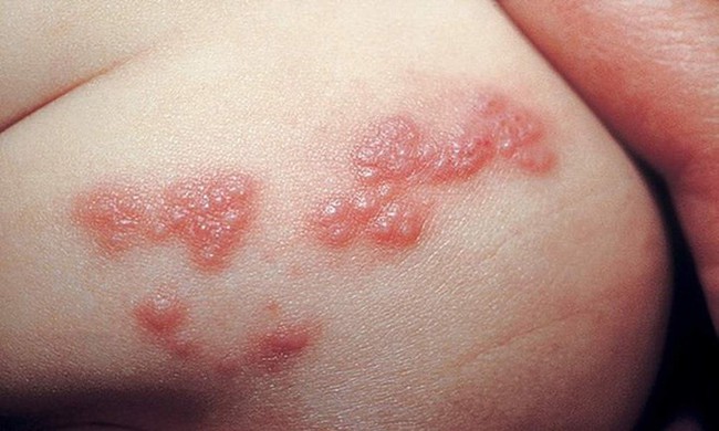 Các triệu chứng Herpes ở phụ nữ không nên bỏ qua - Ảnh 1.