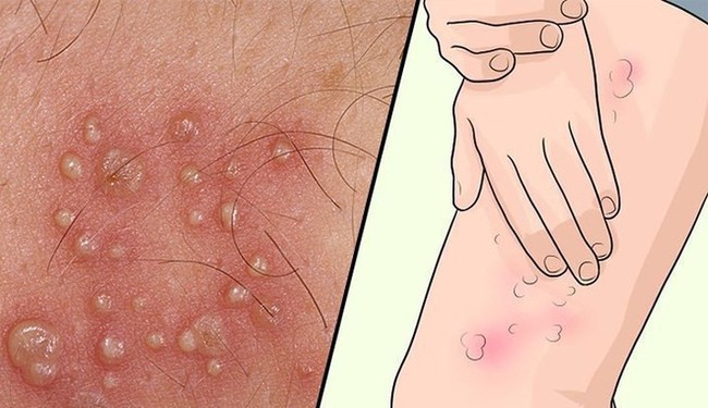 Các triệu chứng Herpes ở phụ nữ không nên bỏ qua - Ảnh 8.