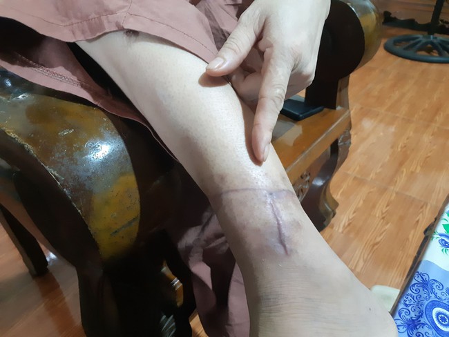 Qua 3 lần đò, người phụ nữ Bắc Giang vẫn không tránh khỏi kiếp gian truân, bị chồng rạch mặt, cắt gân chân vì cuồng ghen - Ảnh 2.