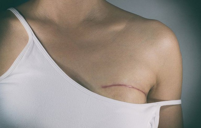 Chủ quan khi thấy vết ố màu xanh lá dính ở phần ngực áo sơ mi, người phụ nữ không ngờ đó là dấu hiệu ung thư vú - Ảnh 3.