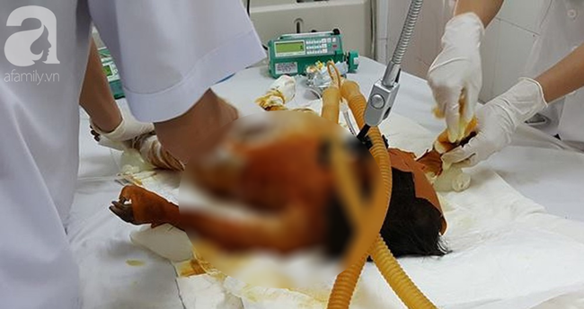 Sóc Trăng: Bố mẹ vắng nhà, 3 chị em chơi đốt rác khiến bé gái 20 tháng tuổi bỏng nặng đến 90% - Ảnh 1. Sóc Trăng: Bố mẹ vắng nhà, 3 chị em chơi đốt rác khiến bé gái 20 tháng tuổi bỏng nặng đến 90% - Ảnh 1.
