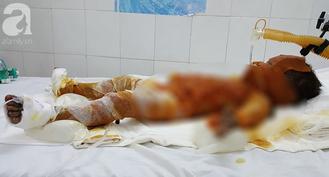 Sóc Trăng: Bố mẹ vắng nhà, 3 chị em chơi đốt rác khiến bé gái 20 tháng tuổi bỏng nặng đến 90% - Ảnh 2. Sóc Trăng: Bố mẹ vắng nhà, 3 chị em chơi đốt rác khiến bé gái 20 tháng tuổi bỏng nặng đến 90% - Ảnh 2.