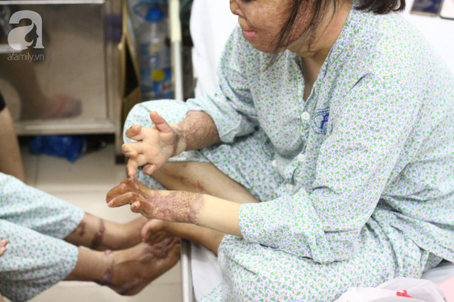 Nụ cười lạc quan và nghị lực sống ngày càng phi thường của cô gái từng bị chồng thiêu sống đúng mùng 2 Tết cách đây hơn 2 năm - Ảnh 8. Nụ cười lạc quan và nghị lực sống ngày càng phi thường của cô gái từng bị chồng thiêu sống đúng mùng 2 Tết cách đây hơn 2 năm - Ảnh 8.