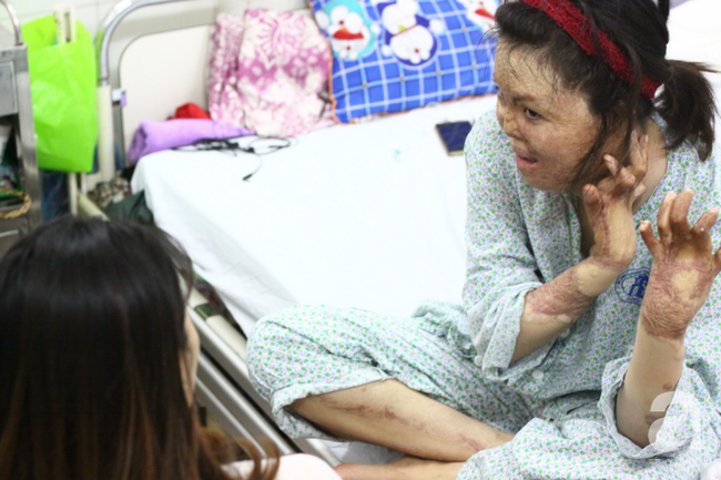 Nụ cười lạc quan và nghị lực sống ngày càng phi thường của cô gái từng bị chồng thiêu sống đúng mùng 2 Tết cách đây hơn 2 năm - Ảnh 2. Nụ cười lạc quan và nghị lực sống ngày càng phi thường của cô gái từng bị chồng thiêu sống đúng mùng 2 Tết cách đây hơn 2 năm - Ảnh 2.