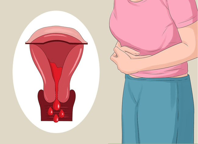 Lạc nội mạc tử cung và 6 dấu hiệu điển hình của căn bệnh này mà con gái không nên chủ quan bỏ qua - Ảnh 1.