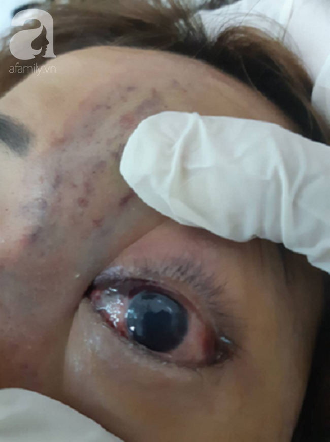 Tiêm filler nâng mũi, nữ sinh viên 20 tuổi ở Sài Gòn đối diện nguy cơ hoại tử da, mù mắt vĩnh viễn - Ảnh 5.