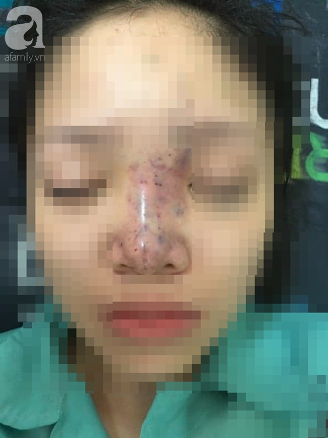 Tiêm filler nâng mũi, nữ sinh viên 20 tuổi ở Sài Gòn đối diện nguy cơ hoại tử da, mù mắt vĩnh viễn - Ảnh 1.