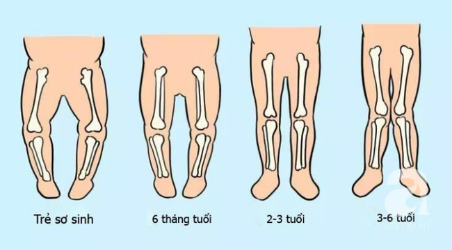 Chỉ mất vài giây để nhận biết chính xác trẻ có mắc tật chân vòng kiềng hay không và cách phòng tránh hiệu quả - Ảnh 2.