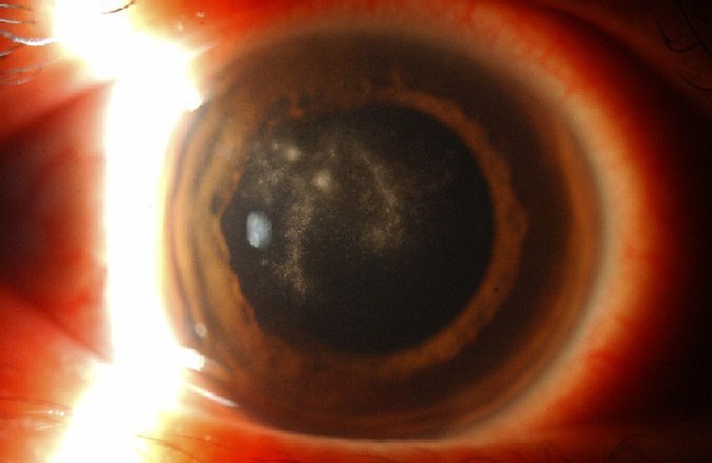 Bùng phát tình trạng nhiễm trùng mắt hiếm gặp bởi lý do này, bất kì ai cũng phải cảnh giác - Ảnh 2.