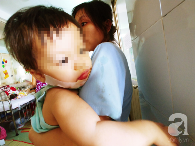 TP.HCM: Mẹ đơn thân tố bảo mẫu làm con gái 18 tháng tuổi bị bỏng nặng ở mặt - Ảnh 2.