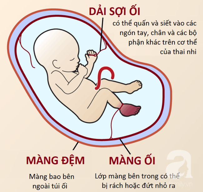 Đừng tưởng tay chân con có ngấn mà mừng, có thể bé đang mắc phải hội chứng nguy hiểm mà bố mẹ không biết - Ảnh 1.