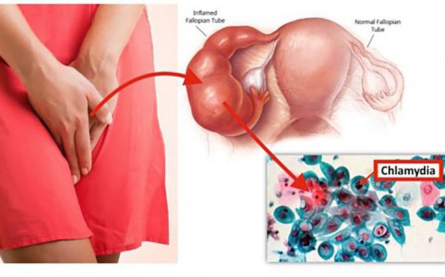 Hình ảnh em bé nhiễm Chlamydia từ mẹ với mắt đầy mủ như lời cảnh tỉnh mạnh mẽ cho những ai coi thường bệnh này - Ảnh 2.