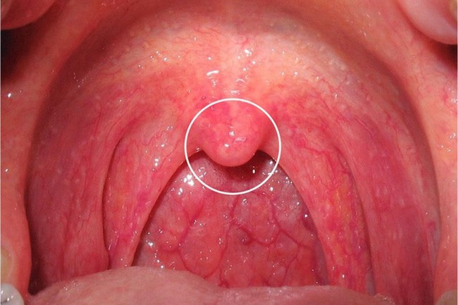 Nước bọt tiết nhiều ở khoang miệng là triệu chứng cảnh báo một vài vấn đề sức khỏe mà bạn không nên xem thường - Ảnh 3.