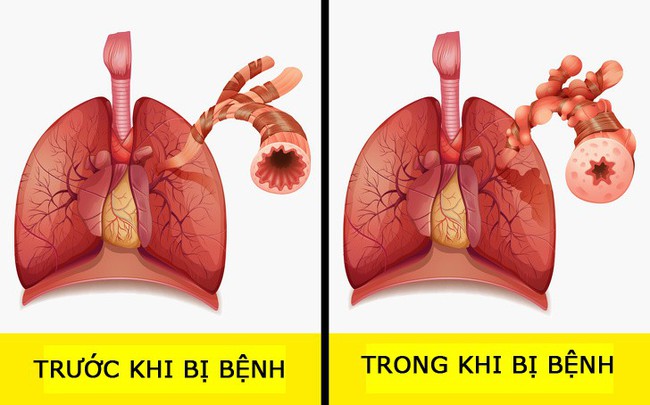 7 triệu chứng dị ứng nhưng chúng ta rất hay nhầm lẫn với bệnh khác nên dễ nguy hiểm nếu không điều trị đúng - Ảnh 6.