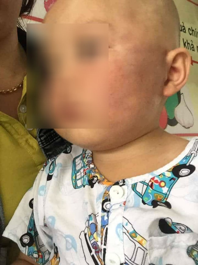 Vĩnh Long: Phẫn nộ bé trai 19 tháng tuổi bị bảo mẫu tát liên tục vào mặt, phải nhập viện điều trị - Ảnh 2.