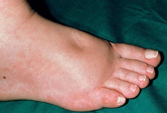 Bàn chân xuất hiện cùng lúc 3 dấu hiệu này: Hãy cảnh giác vì có thể thận đang có bệnh - Ảnh 1.