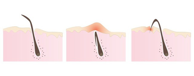 8 vấn đề sức khỏe ở vùng nhạy cảm mọi phụ nữ đều có thể gặp phải và cách khắc phục - Ảnh 8.