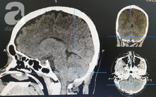 Người đàn ông chấn thương sọ não sau đầu, vỡ gan trước bụng nguy kịch thoát chết nhờ kiểu phẫu thuật có 1 không 2 - Ảnh 3.