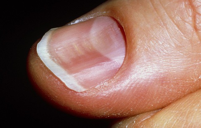 Móng tay xuất hiện dấu hiệu này, bạn có thể bị bệnh tiểu đường hoặc bệnh về máu - Ảnh 2.