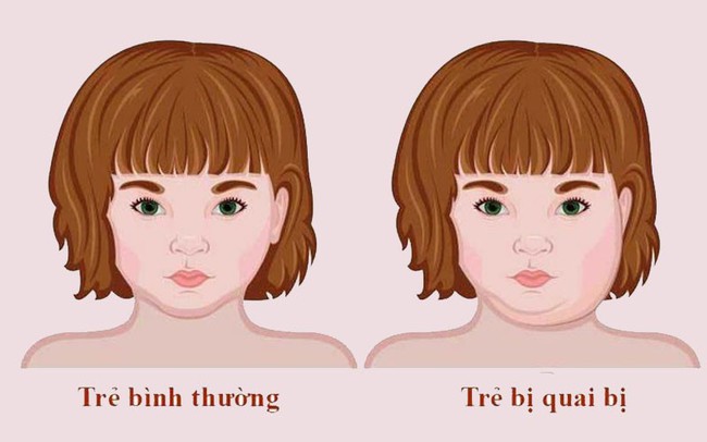 Thời tiết bắt đầu chuyển lạnh, cha mẹ cần đề phòng con mắc bệnh quai bị: Triệu chứng bệnh quai bị ở bé gái và bé trai khác nhau thế nào? - Ảnh 3.