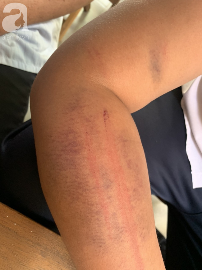 Vết thương vẫn còn in nguyên hình sợi dây điện trên cánh tay K. Vết thương vẫn còn in nguyên hình sợi dây điện trên cánh tay K.