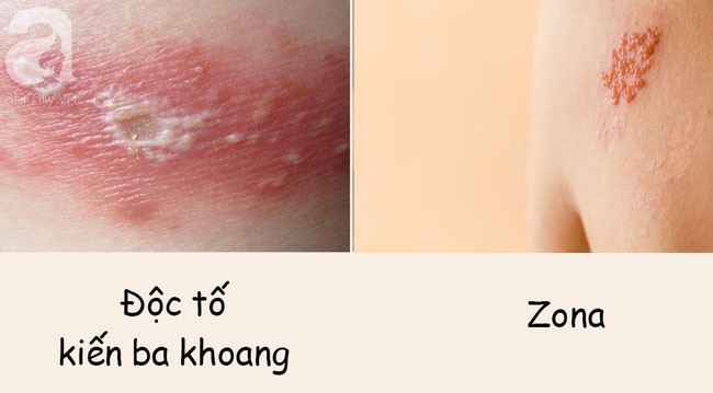 Phân biệt vết thương do kiến ba khoang với viêm da do zona để tránh dùng sai thuốc khiến bệnh khó chữa khỏi - Ảnh 1.