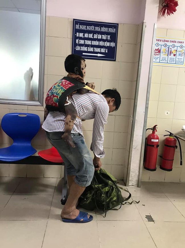 Căn bệnh hiếm gặp  khiến cậu bé Quảng Ninh có toàn bộ cơ thể từ cổ, lưng, mông, đến chân, tay đều là mảng da màu đen - Ảnh 1.