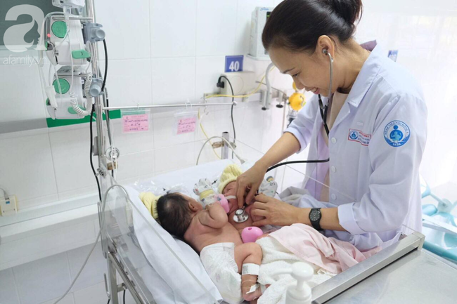 TP.HCM: 18 bác sĩ phẫu thuật tách hai bé gái song sinh dính nhau phần gan, nhỏ nhất từ trước đến nay - Ảnh 2. TP.HCM: 18 bác sĩ phẫu thuật tách hai bé gái song sinh dính nhau phần gan, nhỏ nhất từ trước đến nay - Ảnh 2.