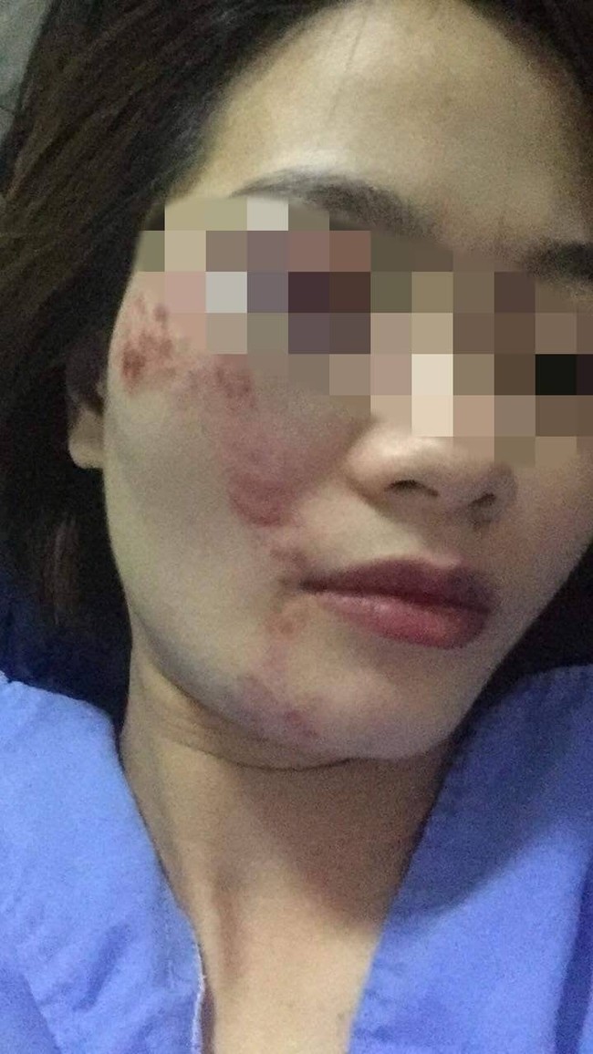 Hà Nội: Nữ nhân viên phụ xe buýt bị khách hành hung nhập viện khi nhắc nhở giữ trật tự - Ảnh 2.