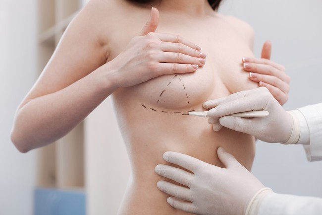 Ngày càng nhiều người tử vong do phẫu thuật nâng ngực: Đây là nguyên tắc sống còn trước khi bạn quyết định làm! - Ảnh 2.