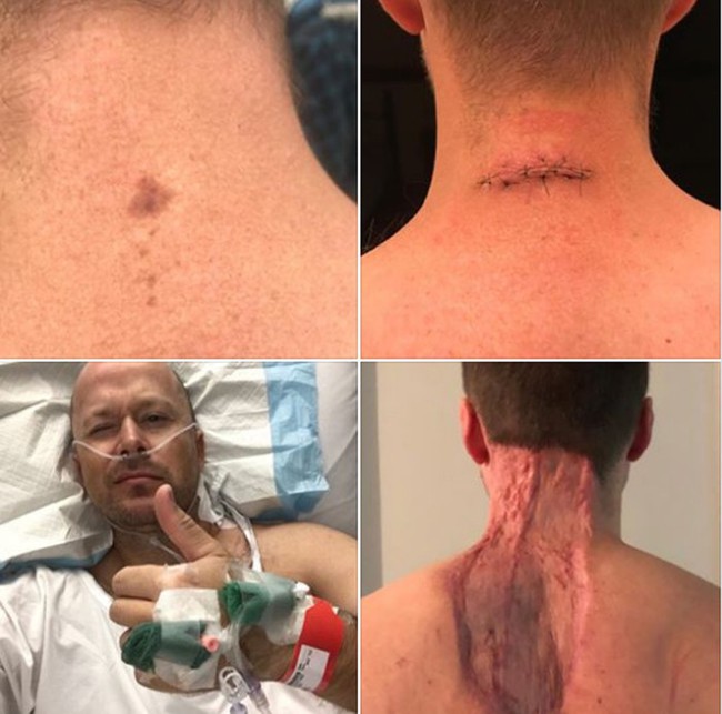 Từ khu vực ung thư da nhỏ xíu, người đàn ông buộc phải lọc da chân ghép lên gáy cổ mới cứu được mạng mình - Ảnh 1.