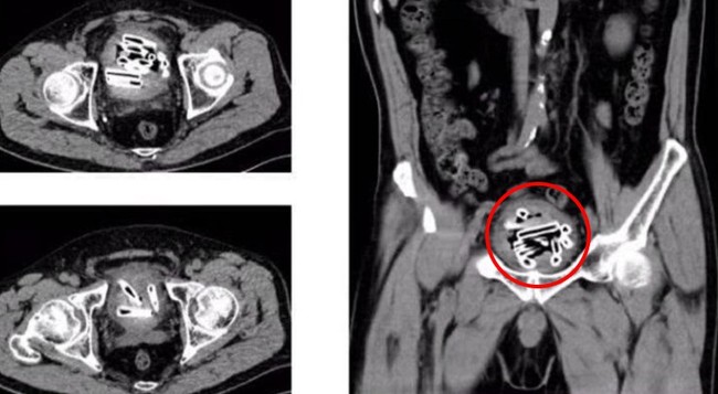 Sau khi li dị vợ, quý ông này đã làm một việc dại dột khiến bác sĩ cũng giật mình khi lấy ra 47 vật thể lạ từ &quot;của quý&quot; của anh - Ảnh 1.