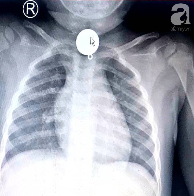 TP.HCM: Ngậm mặt dây chuyền rồi nuốt chửng vào họng, bé trai 2 tuổi bị tắt nghẽn đường thở nguy kịch tại nhà trẻ - Ảnh 1.