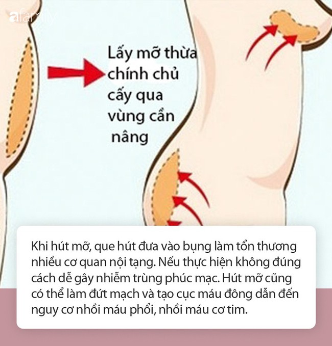 Hút mỡ tự thân để nâng ngực: Chuyên gia khẳng định dễ gặp biến chứng, nguy hiểm tính mạng - Ảnh 4.