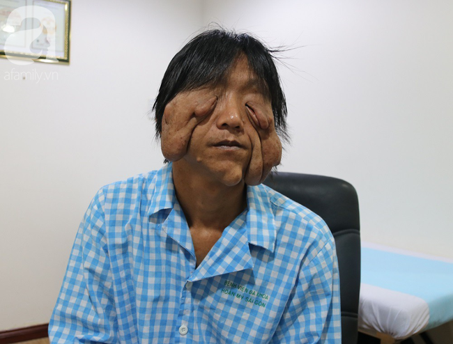 Chàng trai Đắk Lắk bị chảy xệ mặt nặng nề, 17 năm không dám ra đường vì khối u quái ác - Ảnh 1.