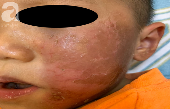 Nguy hiểm: Bé trai 4 tuổi bỏng rộp mặt sau khi đeo mặt nạ siêu nhân chơi Halloween - Ảnh 1.