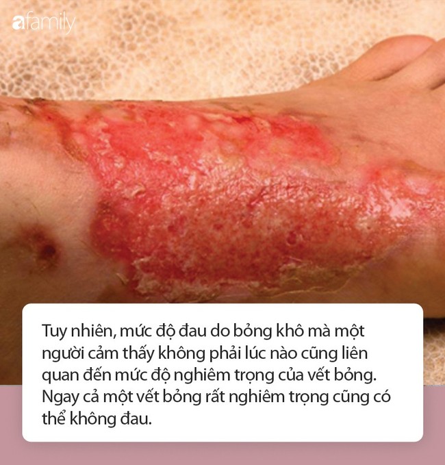 Đi ăn nướng BBQ tại nhà bạn, người phụ nữ bị bỏng khô khiến toàn thân bong trợt phải ghép da - Ảnh 8. Đi ăn nướng BBQ tại nhà bạn, người phụ nữ bị bỏng khô khiến toàn thân bong trợt phải ghép da - Ảnh 8.