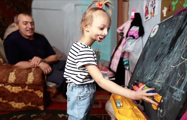 Thường khiến trẻ con sợ hãi với khuôn mặt bị mất một nửa, giờ đây bé gái 6 tuổi đã có thể nở nụ cười đầu tiên trong cuộc đời - Ảnh 3.