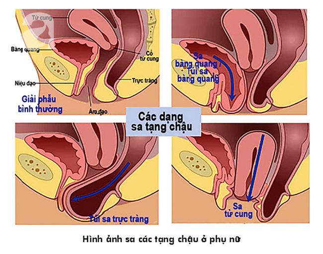 Người phụ nữ liên tục bị són tiểu và khó chịu vùng âm đạo: Cảnh giác với căn bệnh &quot;khắc tinh&quot; của chị em - Ảnh 2.