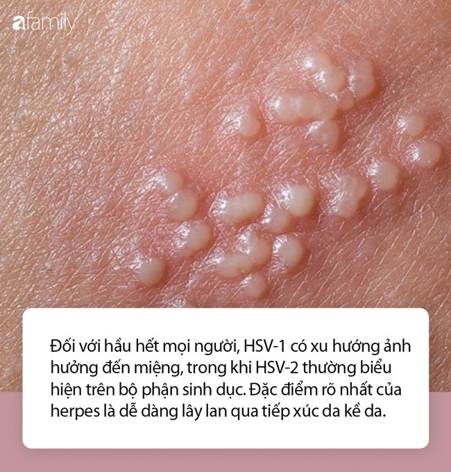 Nhầm tưởng về bệnh herpes không ít phụ nữ mắc phải - Ảnh 2.